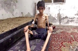 Jovem desnutrido por falta d alimentos na Síria/Foto: Local Revolutionary Council in Madaya/AP)