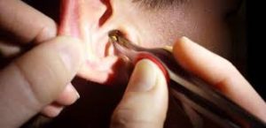 Homem luta para tirar inseto do ouvido em ST