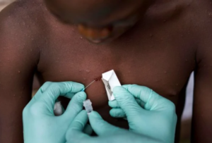 OMS confirma 94 novos casos de varíola dos macacos e prevê aumento