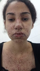 Serra-talhadense sofre com uma doença rara e luta pela vida