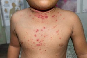 Varíola dos macacos atinge crianças e ST tem 2 casos notificados