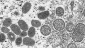 Sobe para 164 número de casos de varíola