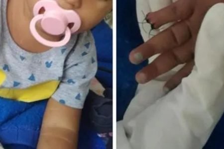 Menina de 2 anos tem parte do dedo amputado