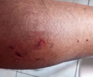 Pedreiro sofre ataque feroz de animal em bairro de ST