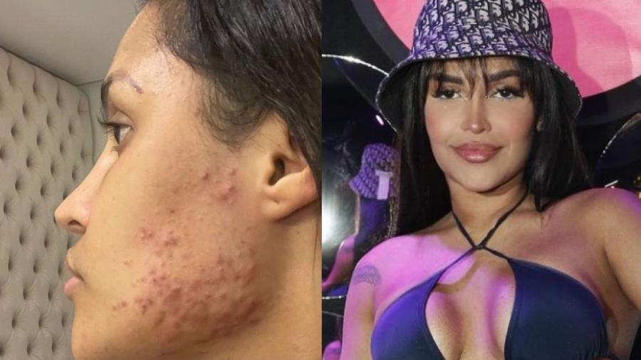 Flay fala sobre efeitos colaterais do 'chip da beleza': 'Ganhei 10 quilos'