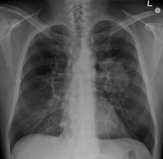 Câncer de pulmão: novo remédio reduz risco de morte em 51%