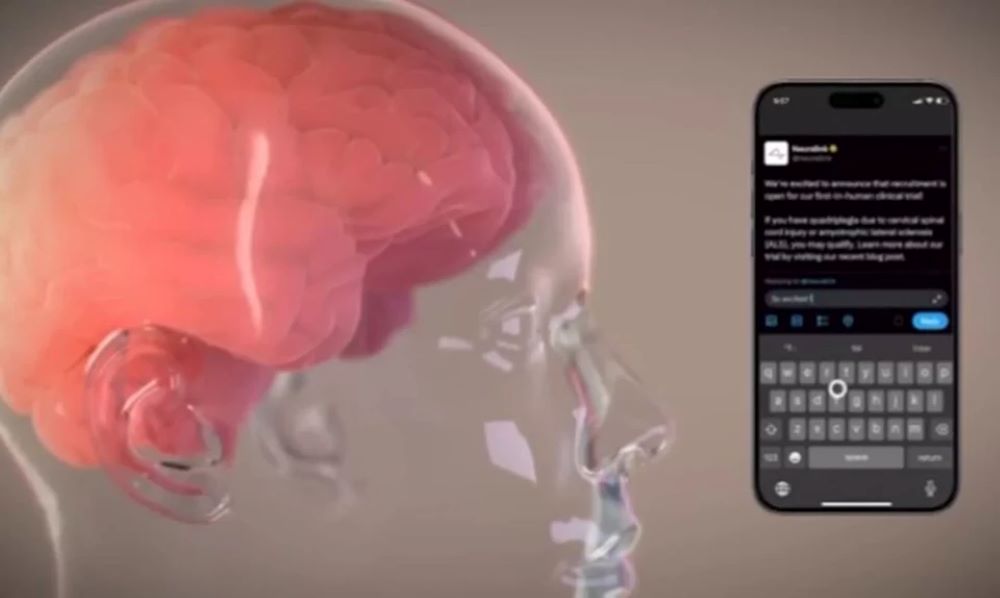 1º implante do chip em cérebro humano é anunciado por Elon Musk