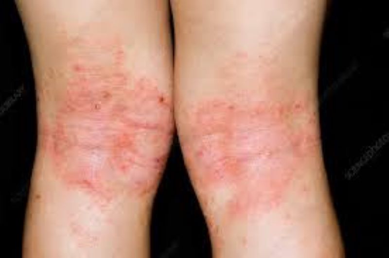 Dermatite atópica: conheça os sintomas e as formas de tratamento