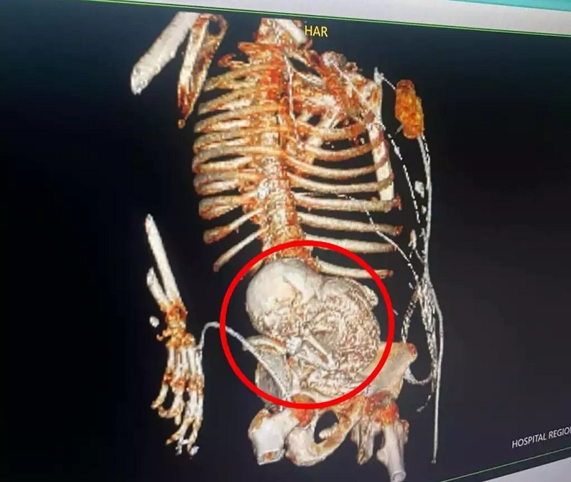 Mulher descobre feto mumificado há 56 anos no útero 1 Mulher descobre feto mumificado há 56 anos no útero