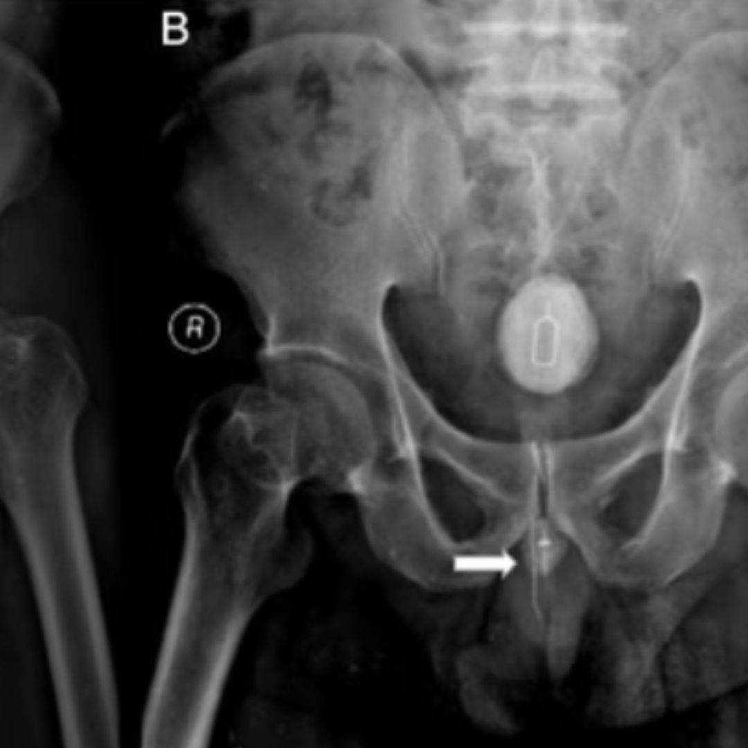 Homem passa por cirurgia após enfiar chave para retirar chip no pênis