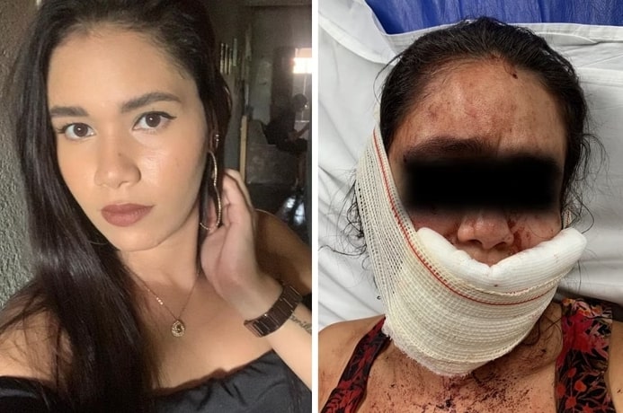 “Perdeu 50% dos lábios”, diz prima de mulher atacada por homem após rir dele 1 “Perdeu 50% dos lábios”, diz prima de mulher atacada por homem após rir dele - Foto: Arquivo Pessoal