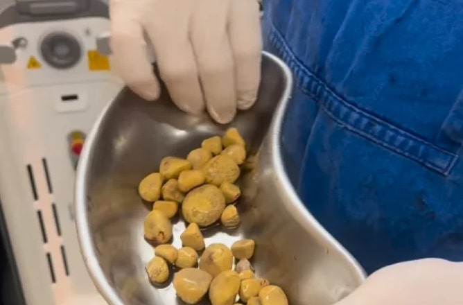 Médico retira 35 pedras da bexiga de homem que bebia refrigerante todo dia 1 Médico retira 35 pedras da bexiga de homem que bebia refrigerante todo dia - Imagem: Reprodução/Redes sociais