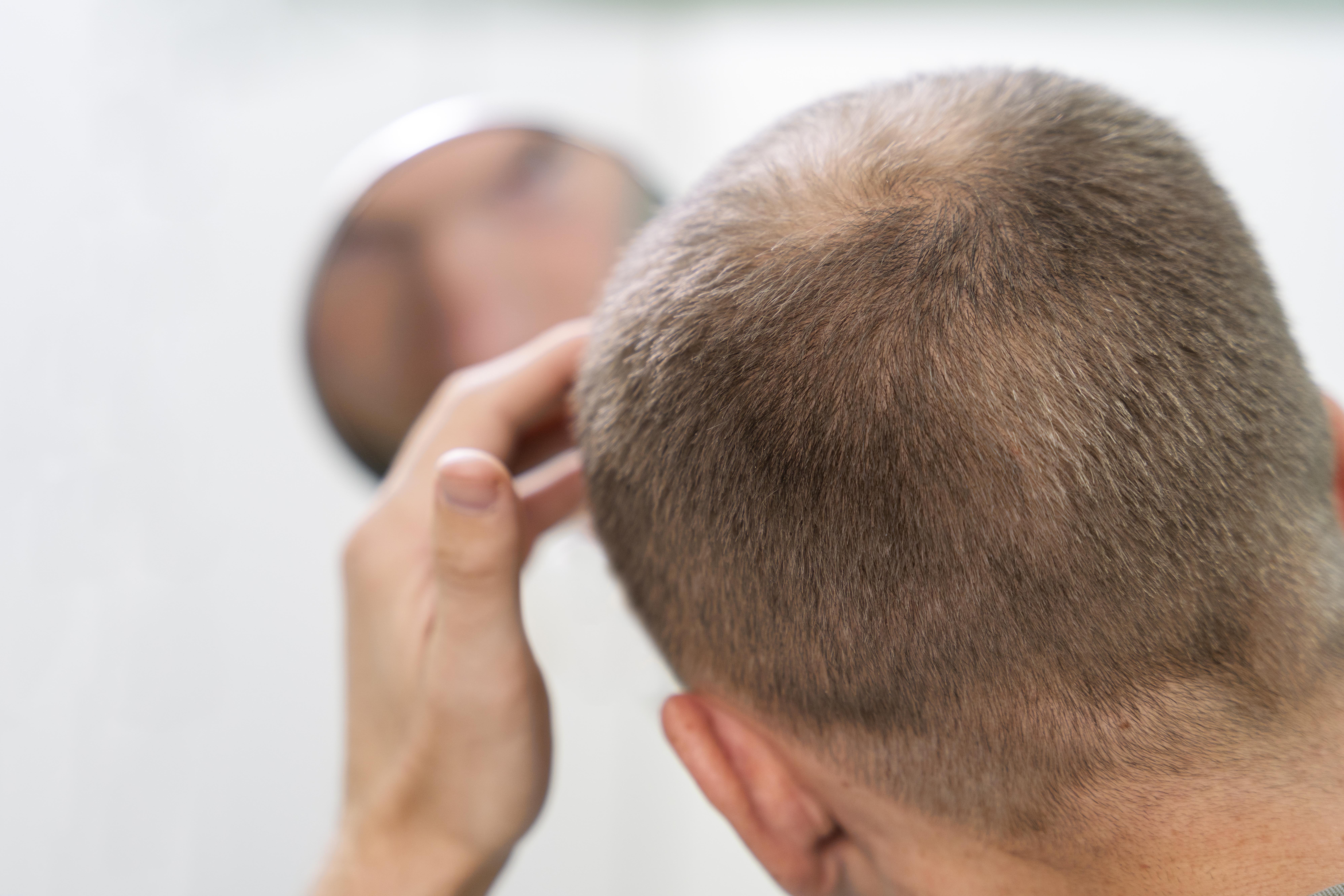Fim dos carecas? Cientistas criam produto que faz o cabelo voltar a crescer 1 Fim dos carecas? Cientistas criam produto que faz o cabelo voltar a crescer - Foto: Freepik