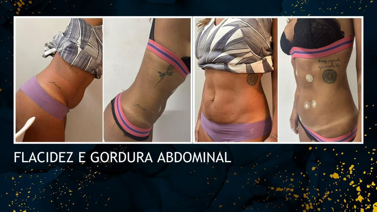 Clínica traz para ST inovadora Mini Lipo sem cortes e Endolaser