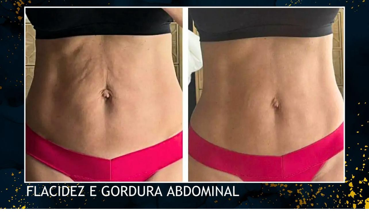 Clínica traz para ST inovadora Mini Lipo sem cortes e Endolaser