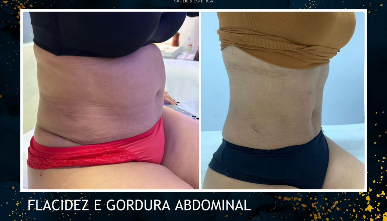 Clínica traz para ST inovadora Mini Lipo sem cortes e Endolaser