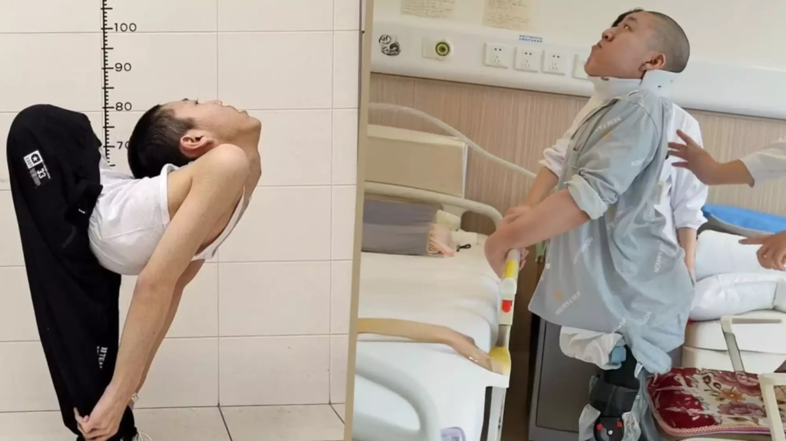 Jovem com 'corpo dobrado' fica em pé e se deita pela primeira vez após cirurgia 1 Menino com 'corpo dobrado' fica em pé e se deita pela primeira vez após cirurgia - Foto: Reprodução/South China Morning Post