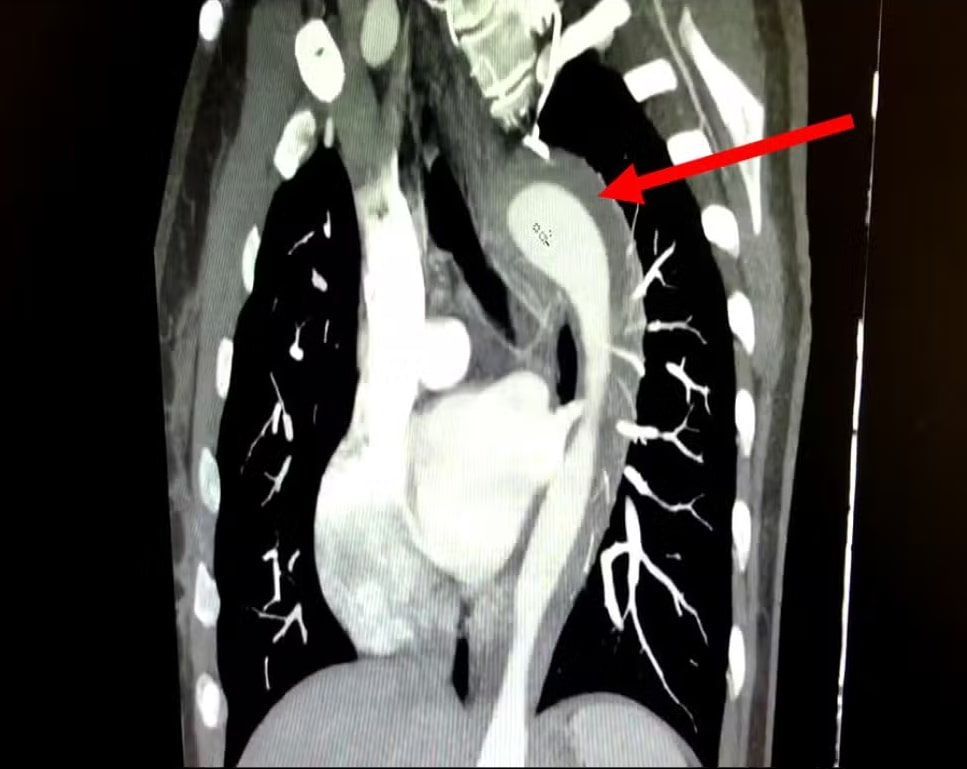 Em caso raro, mulher de 45 anos rompe aorta após orgasmo; entenda a condição 1 Em caso raro, mulher de 45 anos rompe aorta após orgasmo; entenda a condição - Foto: American Journal of Case Reports