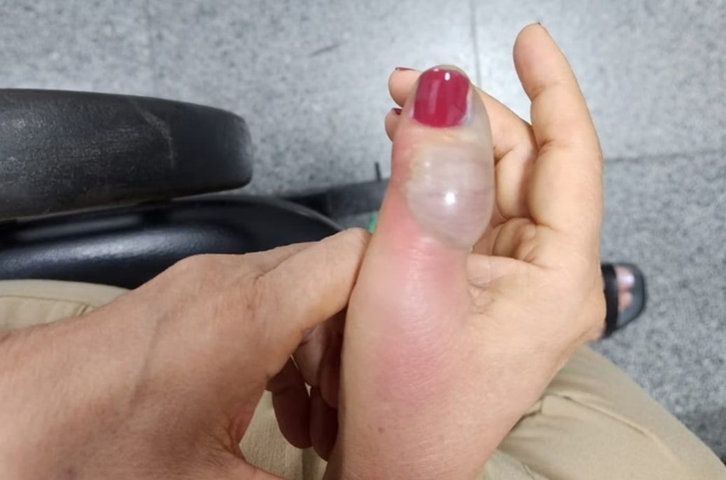 Mulher tem infecção após fazer as unhas e passa por 4 cirurgias 1 Mulher tem infecção após fazer as unhas e passa por 4 cirurgias - Foto: Reprodução/Acervo Pessoal