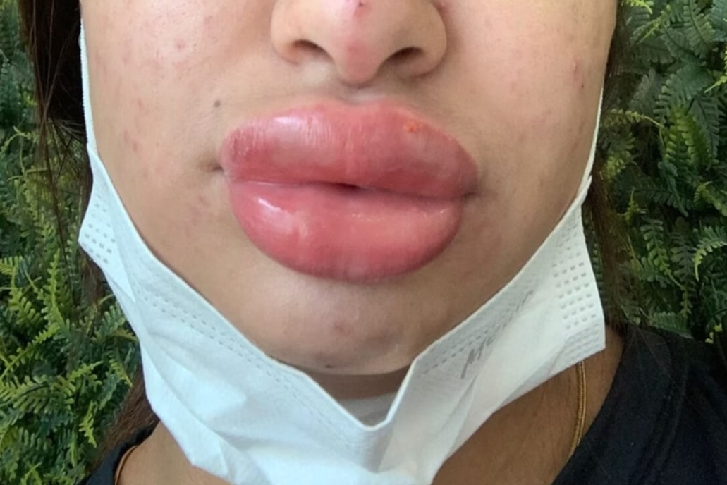 Mulher fica com rosto deformado após procedimento que custou R$ 1 mil - Foto: Arquivo pessoal