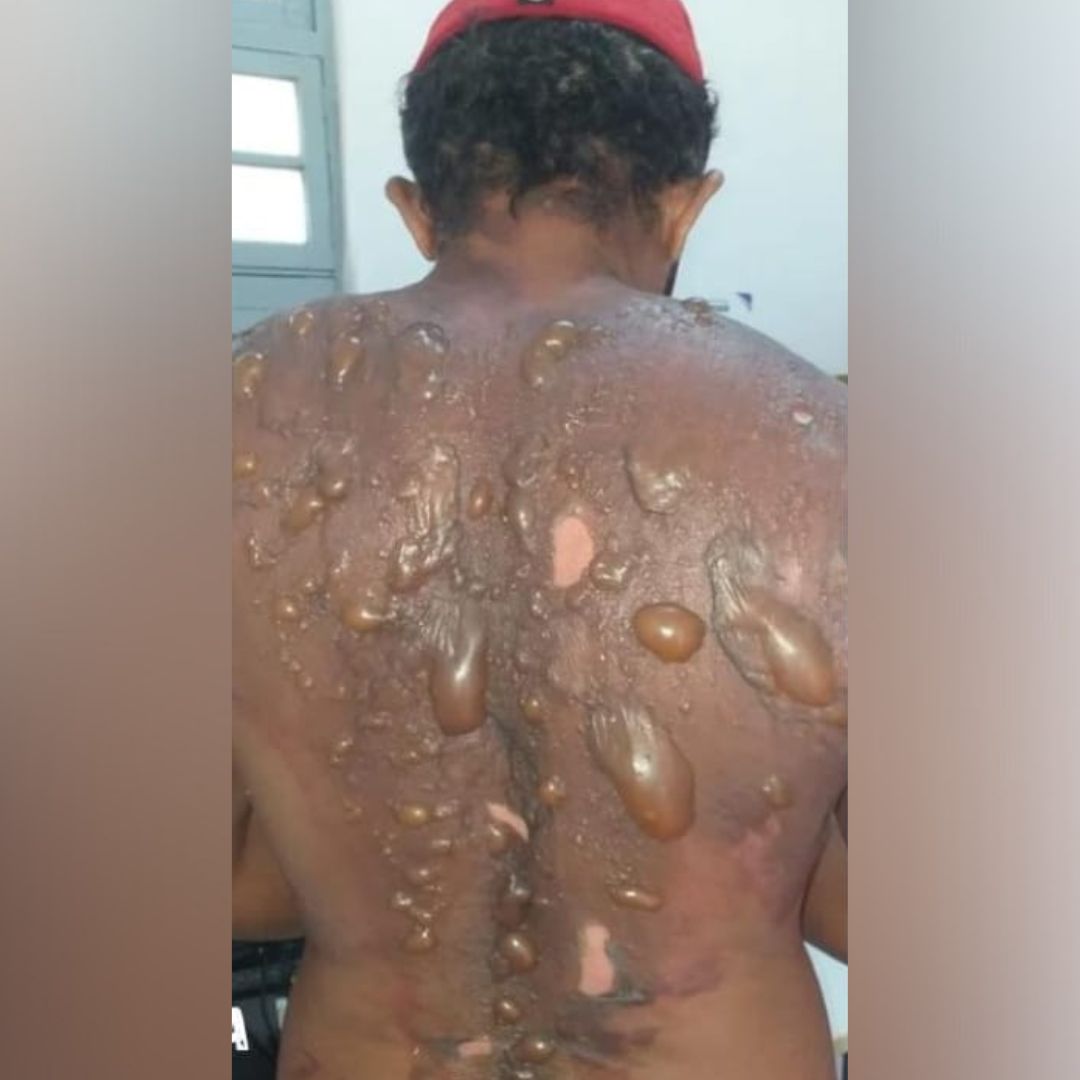 Farol entrevista vítima de ataque com água fervente em Serra Talhada