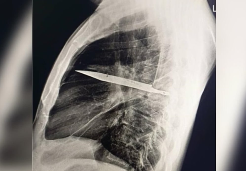 Homem sente dor no peito e descobre faca alojada no corpo há oito anos - Foto: Journal of Surgical Case Reports
