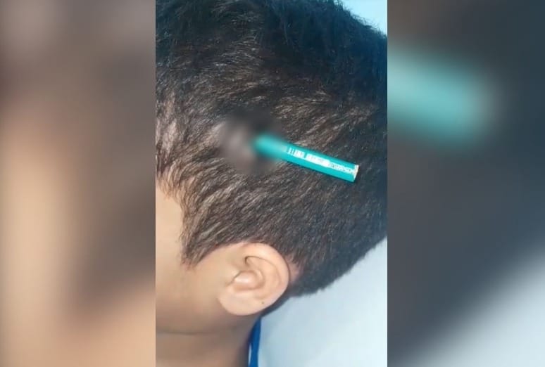 Menino tem lápis fincado na cabeça após agressão de colega em escola - Foto: Reprodução