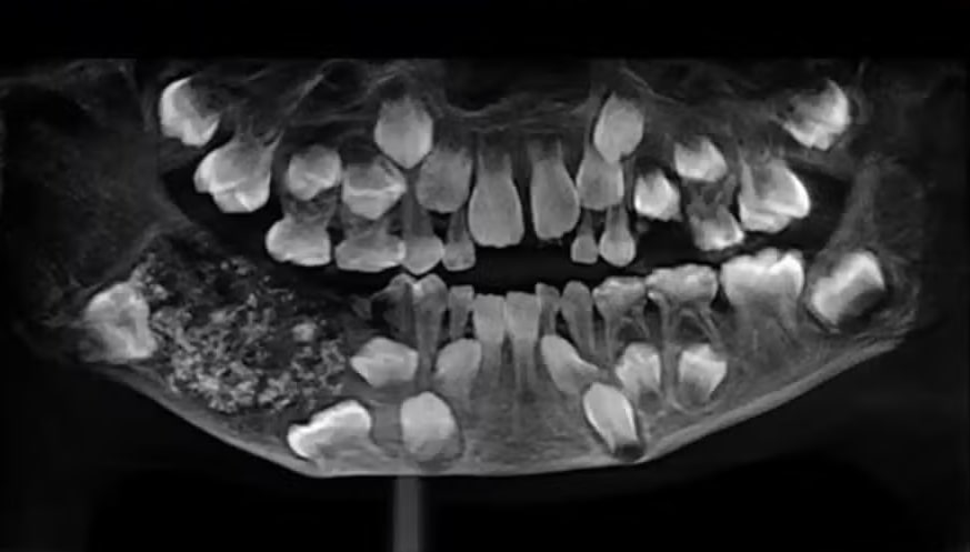 Cirurgia na Índia remove 526 dentes da boca de um menino de sete anos - Foto: Saveetha Dental College and Hospital/Reprodução
