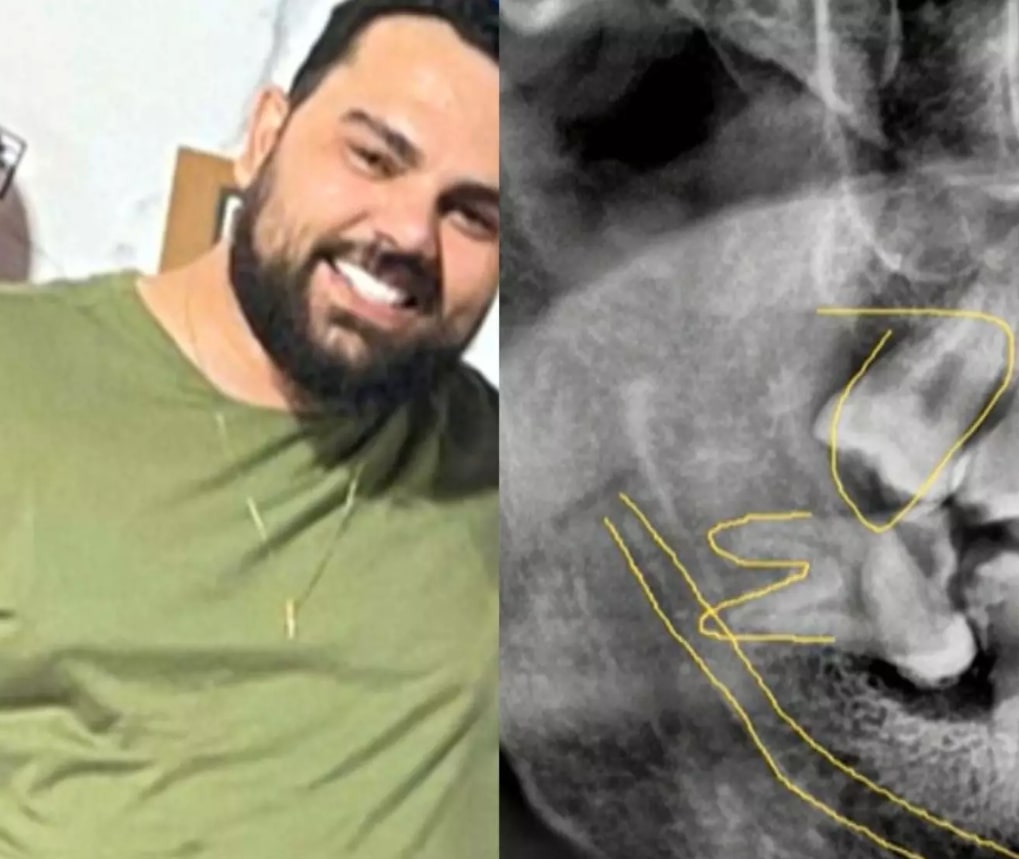 Homem morre após cirurgia para retirada do dente siso em Goiás 1 Homem morre após cirurgia para retirada do dente siso em Goiás - Foto: Reprodução