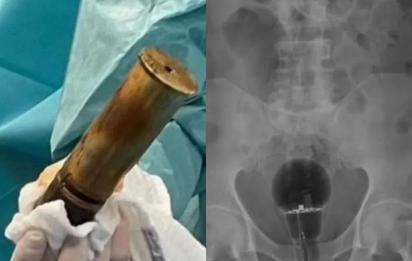 Bomba, desodorante, coco e lâmpada: veja 8 casos de objetos presos no reto 1 Bomba, lâmpada, coco e desodorante