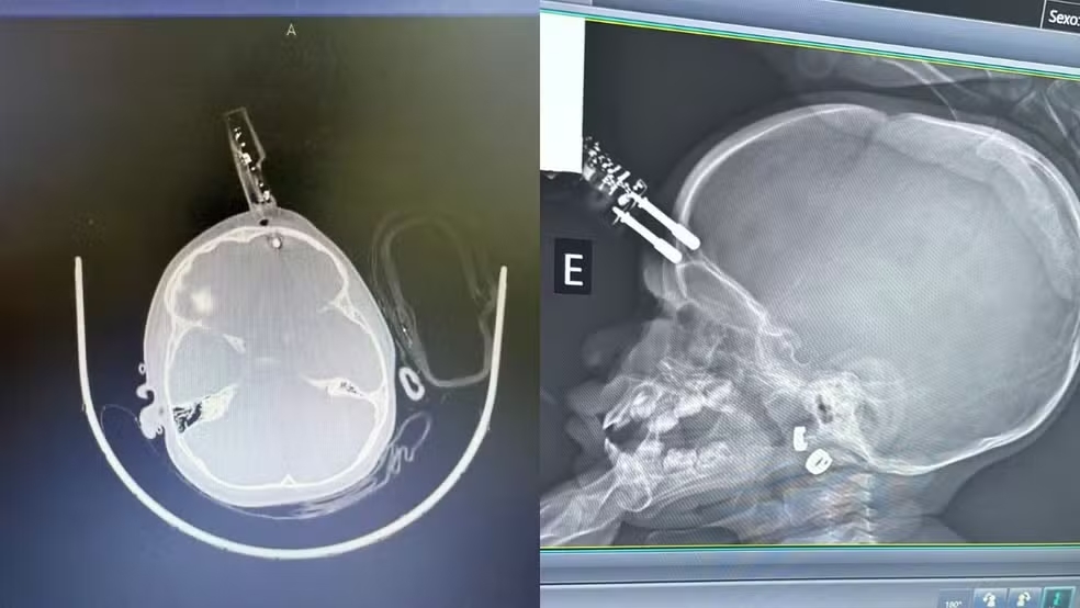 Menina de 1 ano fica com carregador cravado na testa após cair da cama