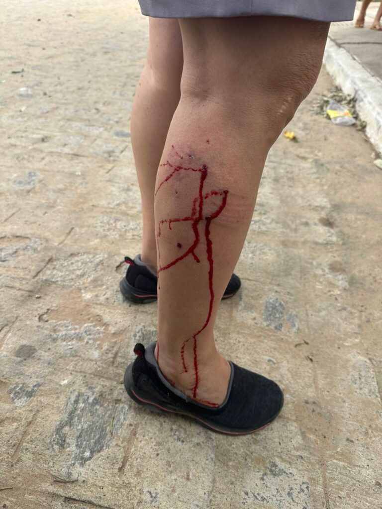 Mulher é atacada por 10 cães no bairro AABB, em Serra Talhada 1 Mulher é atacada por 10 cães no bairro AABB, em Serra Talhada