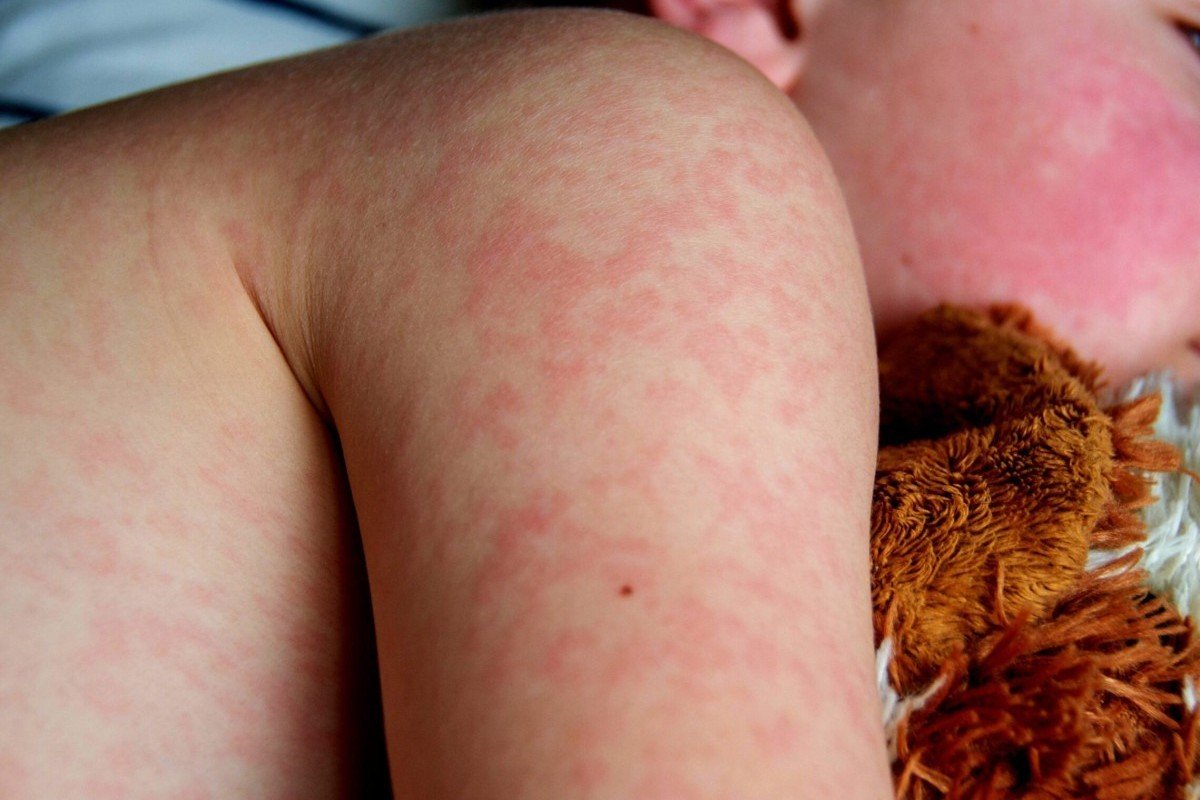 Com mais de mil casos, Pensilvânia enfrenta o maior surto de sarampo em décadas 1 A melhor proteção contra o sarampo continua sendo a vacinação completa (Divulgação/MS)